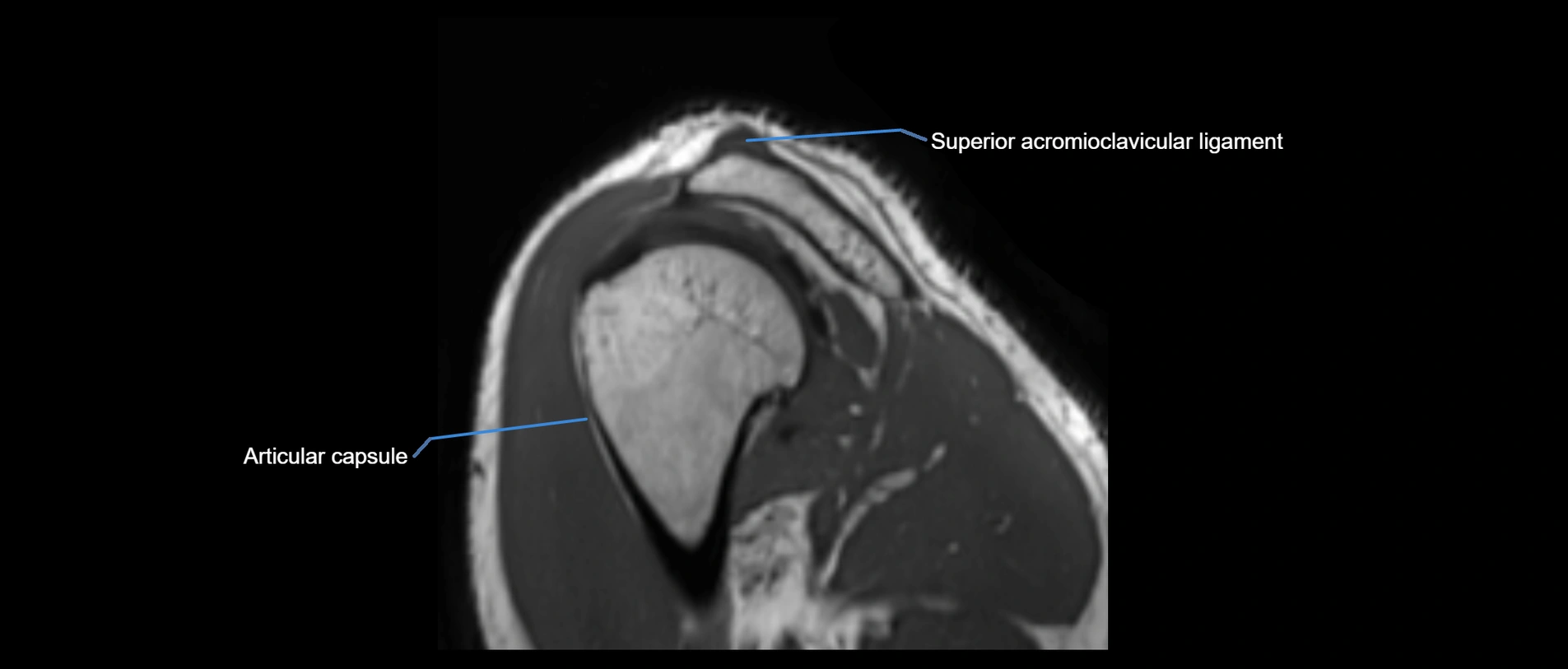 shoulder ligaments sagittal  cross sectional anatomy 3T MRI AI enhanced radiology image -img-00001-00046.webp